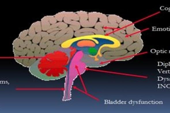 النساء أكثر عرضة للإصابة بمرض التصلب المتعدد مقارنة بالرجال