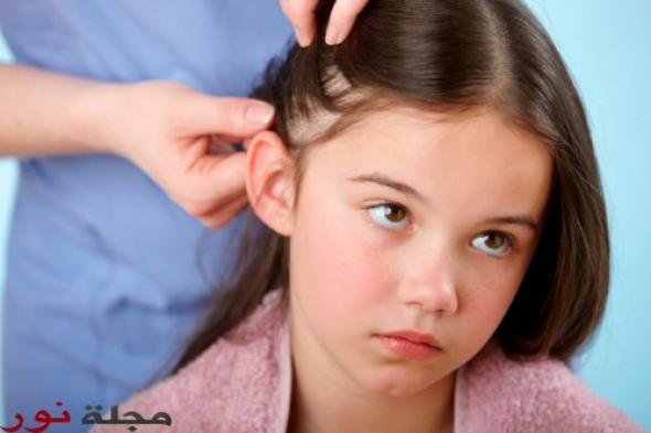 5 علاجات طبيعية للتخلص من قمل الرأس