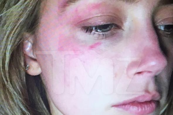 آمبر هيرد تثبت تعدي جوني ديب عليها بالضرب بصورة.. وتحصل على أمر بعدم التعرض
