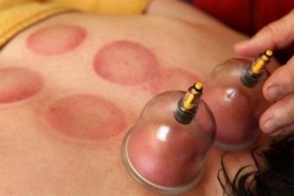 من الطب الصيني القديم.. فوائد صحيّة مذهلة للحجامة