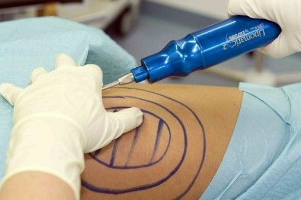 شفط الدهون تجميل أم ضرورة صحية؟
