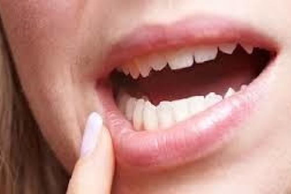 طرق سريعة للقضاء على تقرحات الفم