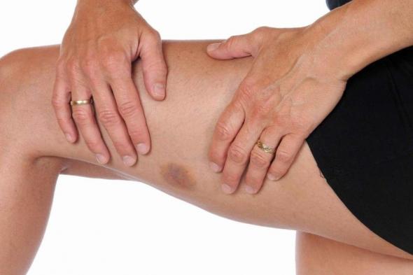 أسباب وعلاج ظهور الكدمات في الجسم