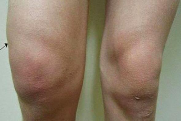 هل يحتبس الماء في ركبتيك؟ إليك حيلة طبيعية تريحك من هذه المشكلة