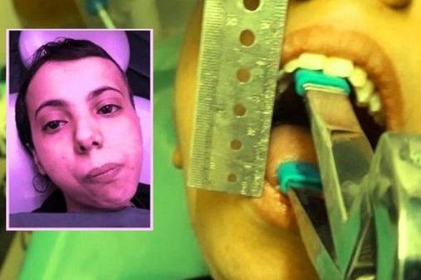 مرض منع فاطمة من فتح فمها طوال 30 عاماً.. وجراحٌ يحل المشكلة بـ4 ساعات!